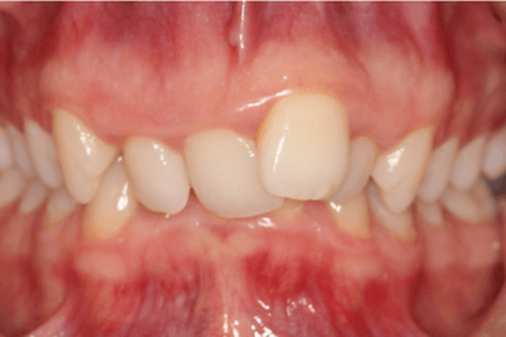 Before treatment: Crowding
