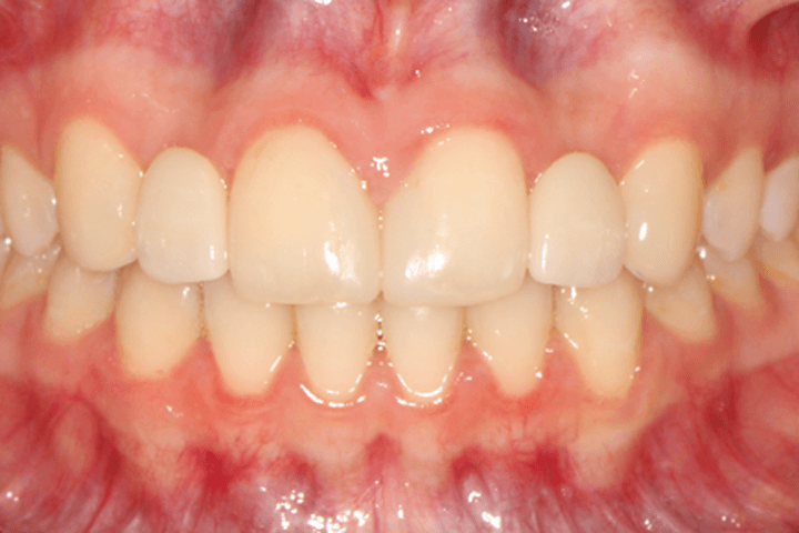 After treatment: Spacing
