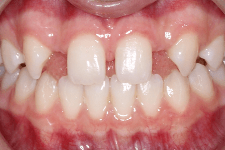 Before treatment: Spacing