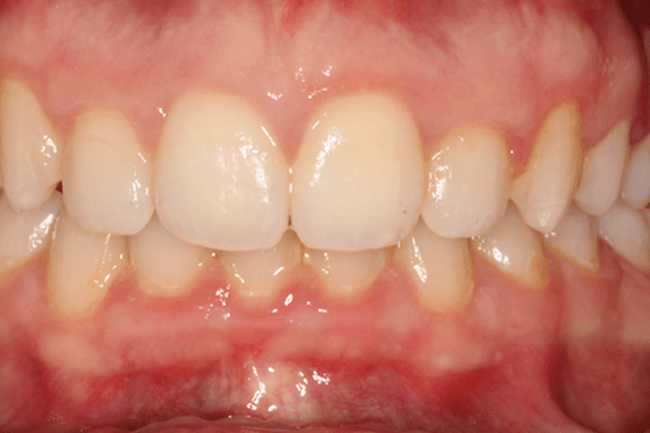 After treatment: Crowding: case 1