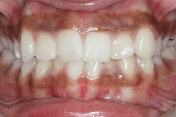 Before treatment: Crowding: case 3