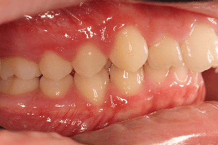 Before treatment: Overbite