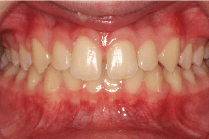 Before treatment: Spacing: case 2