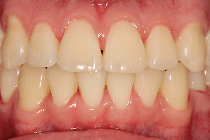 After treatment: Underbite