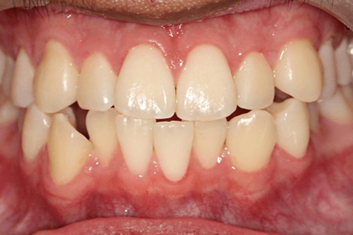 Before treatment: Underbite