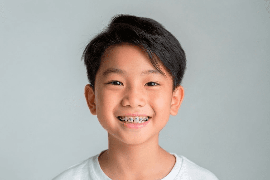 A young child smiling, wearing braces on the upper teeth
